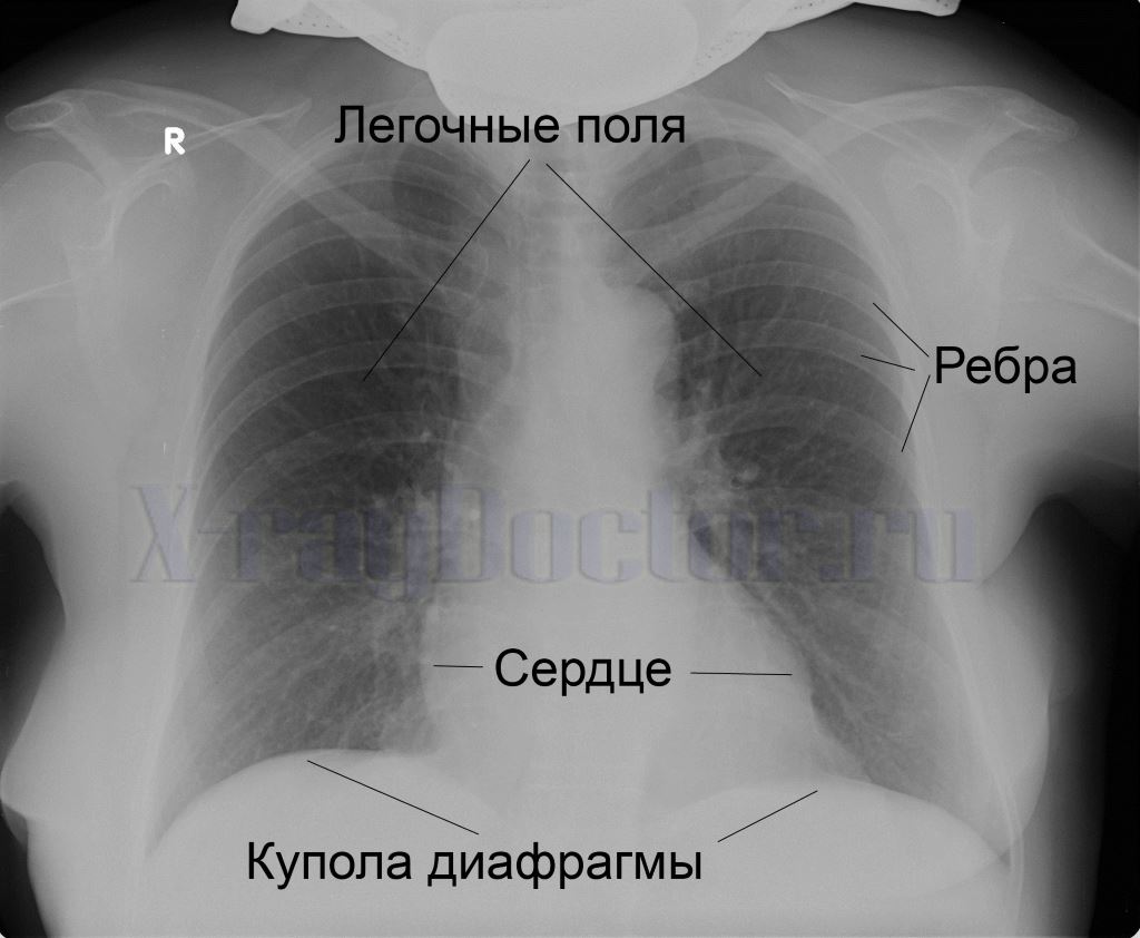 рентген снимок здоровых легких